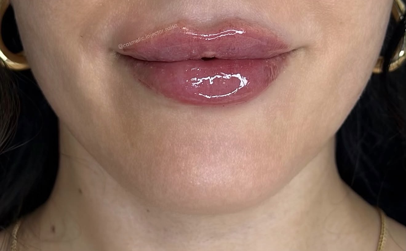Lip Filler after