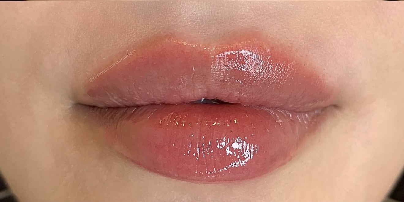 Lip Filler after