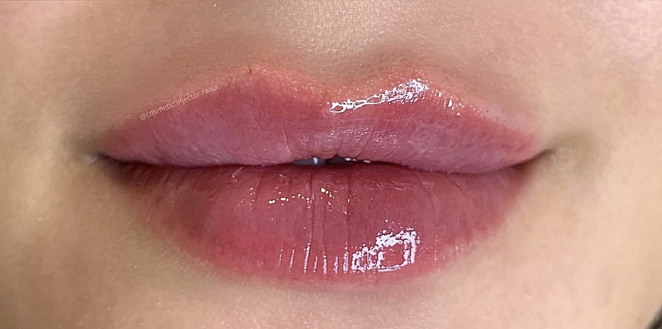 Lip Filler after