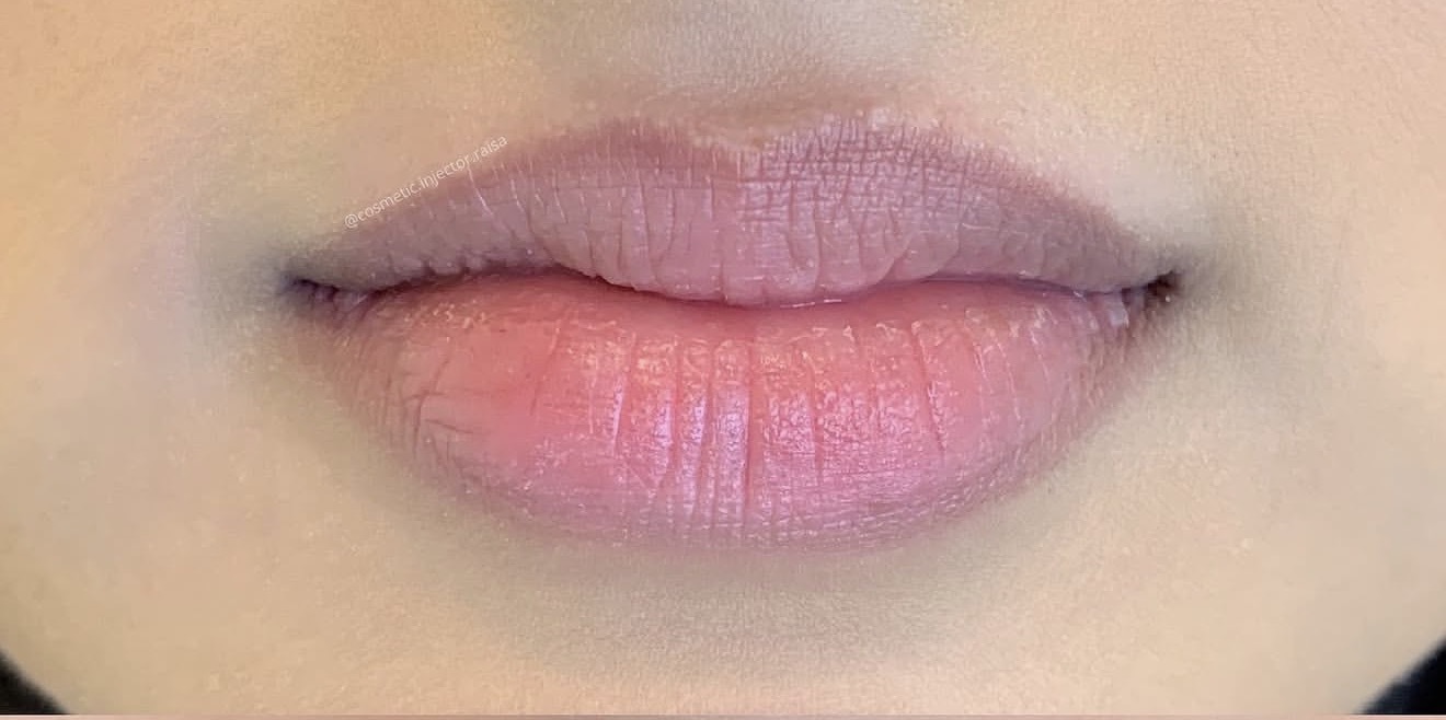 Lip Filler before
