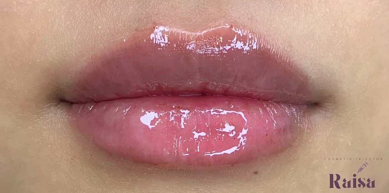 Lip Filler after
