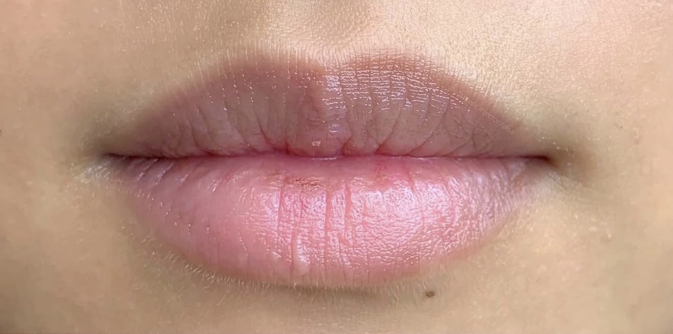 Lip Filler before