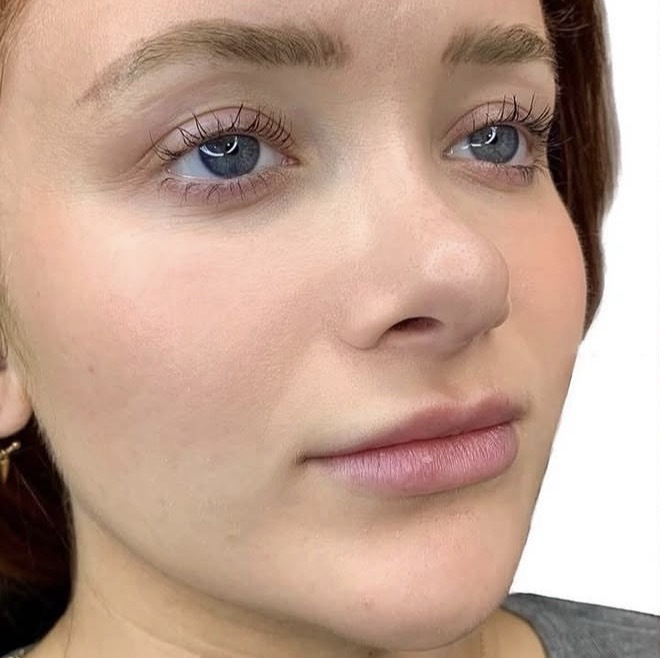 Lip Filler before