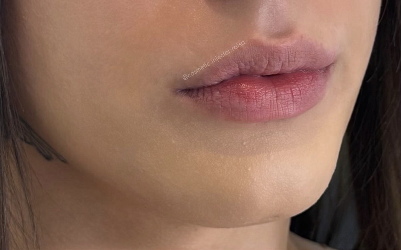 Lip Filler before