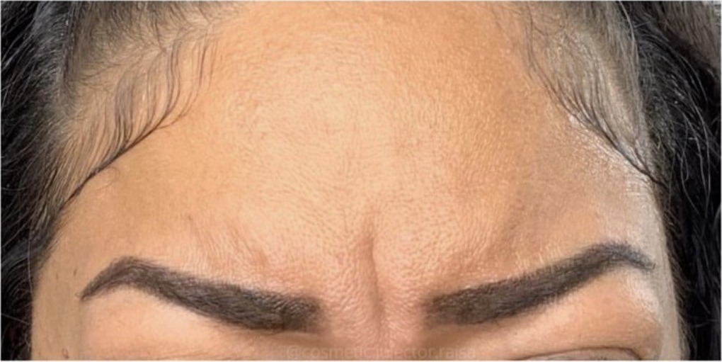 Botox before
