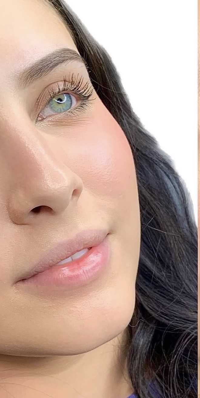Lip Filler before