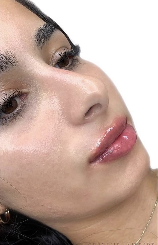 Lip Filler after